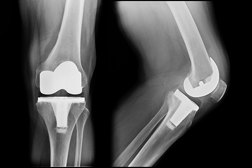 knee replacement xray